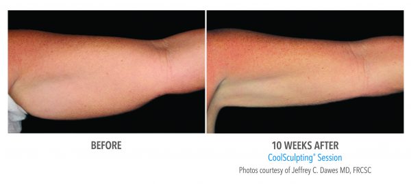 coolsculpting before and after arms
