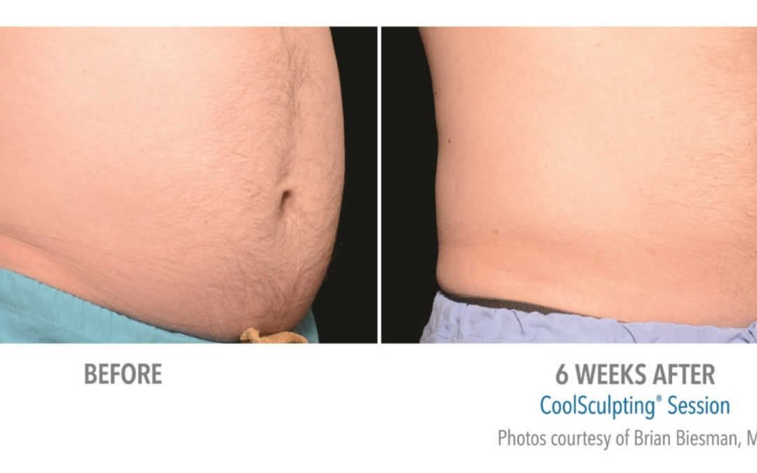 coolsculpting before and after stomach