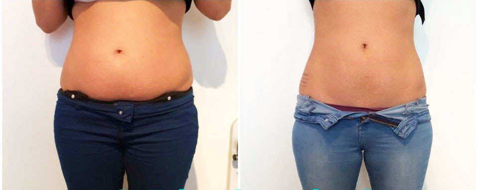 ultrasonic cavitation vs coolsculpting